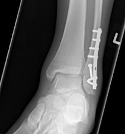 Ankle Weber B Deltoid Ligament ORIF