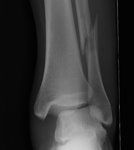 Ankle Weber C Fracture.jpg