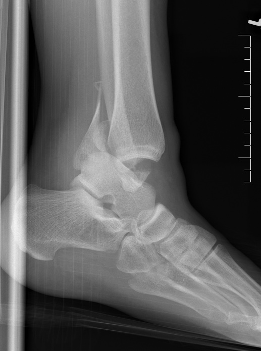 disl ankle 2