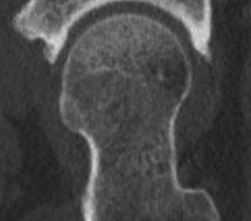 Hip Cam CT Sagittal.jpg