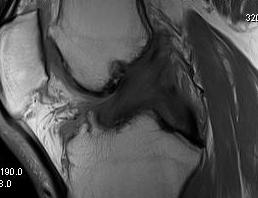 Knee Torn ACL and PCL0002
