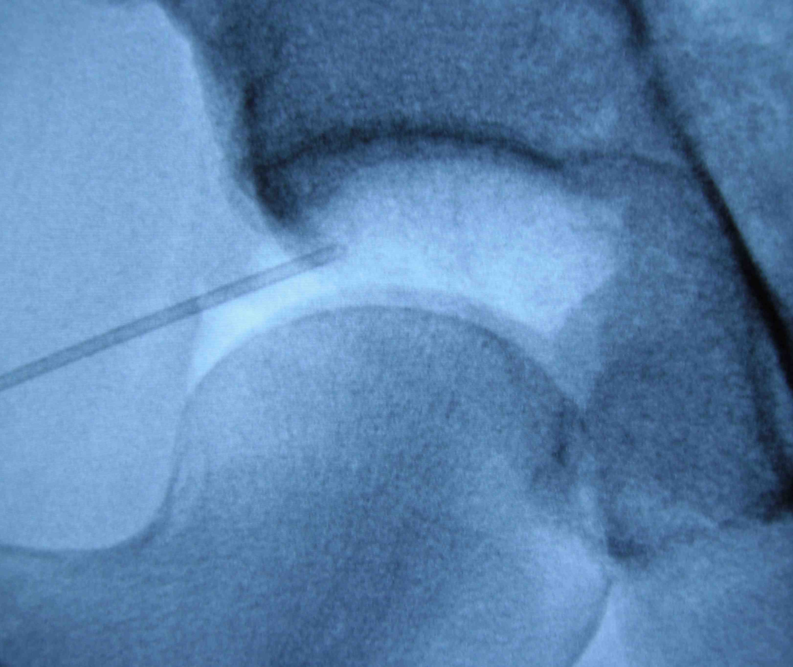 Hip Scope Air Arthrogram