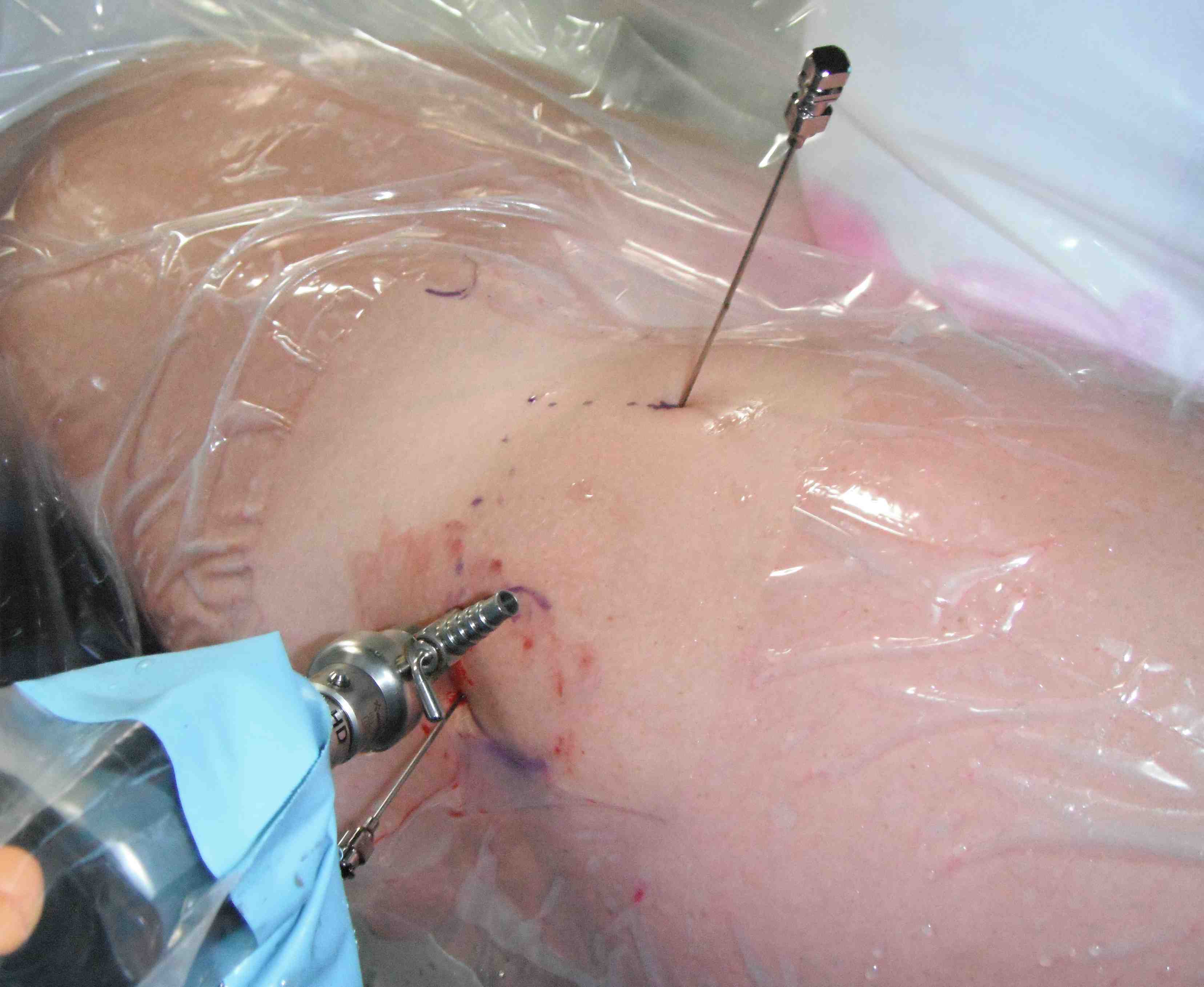 Hip Scope Anterior Portal 1_0