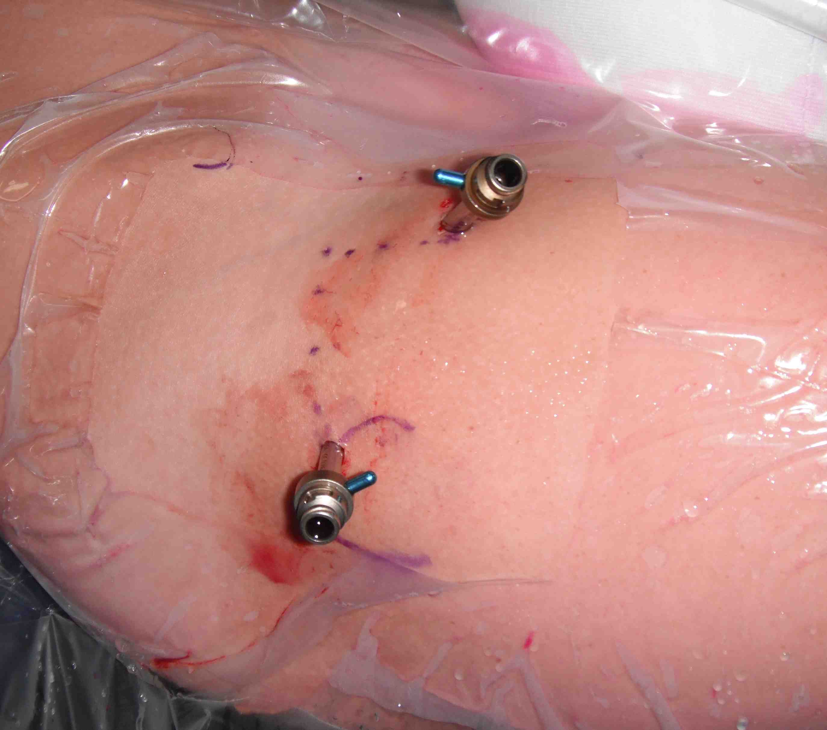 Hip Scope Anterior Portal 2_0